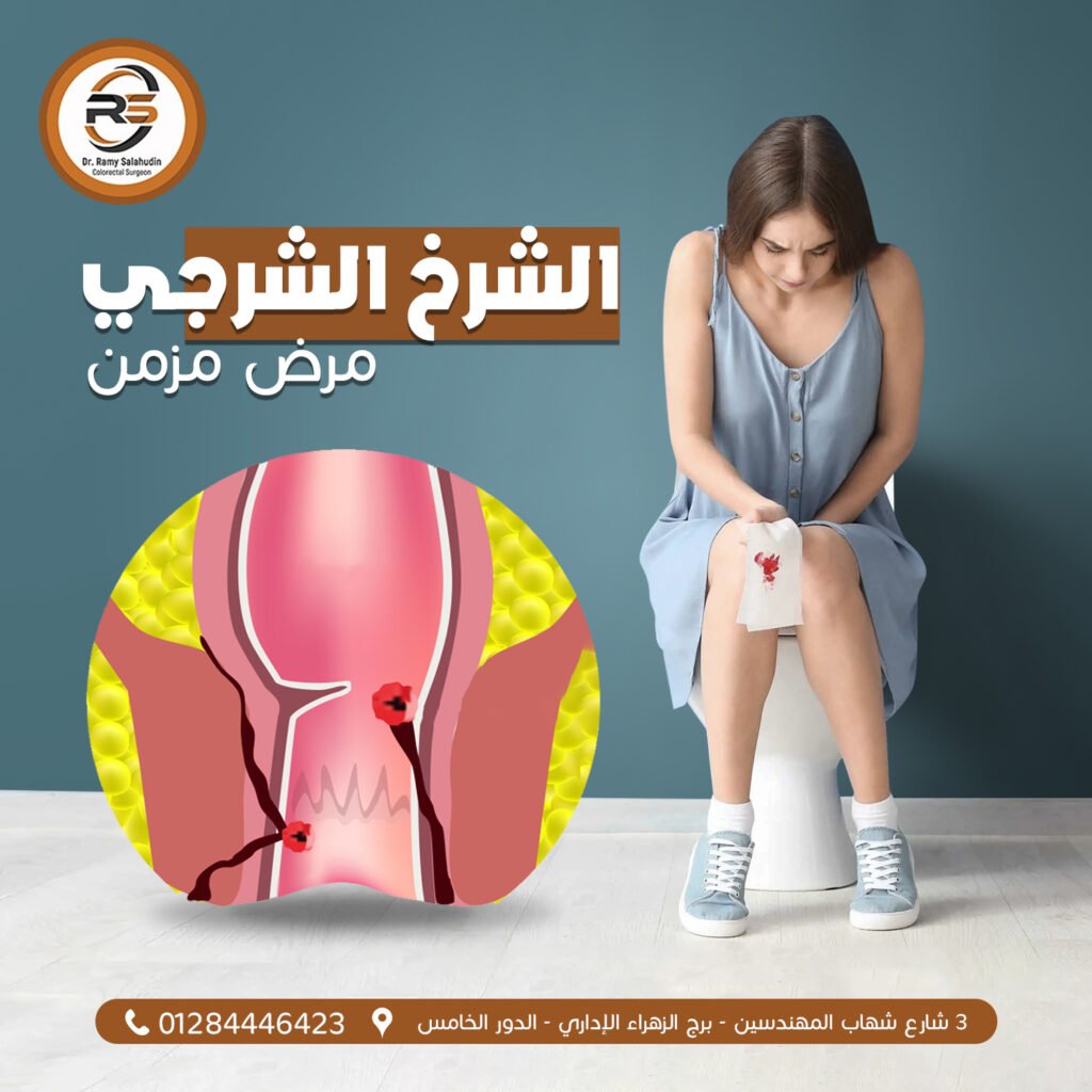 الشرخ الشرجي